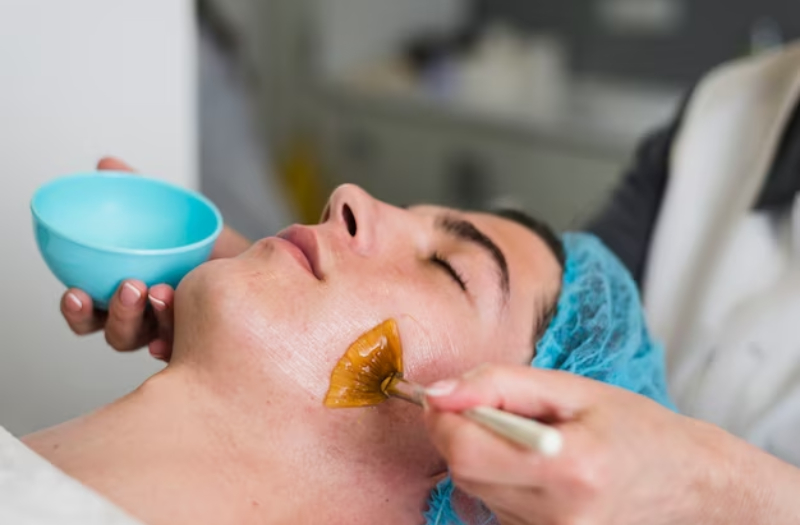 chemical peels for acne scars

