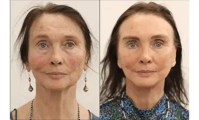 Facelift Surgery In London: A Path To Youthful Beauty