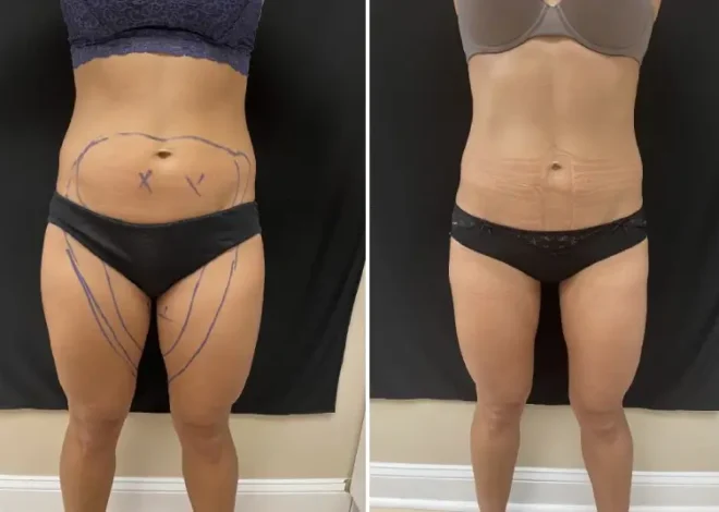 Everything You Need To Know About Liposuction In Washington DC