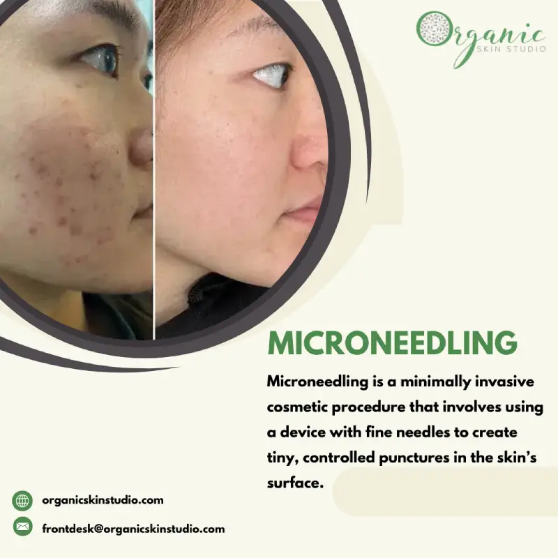 Microneedling