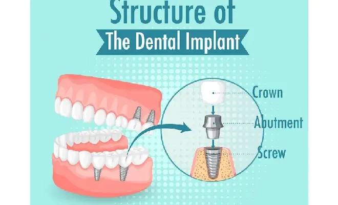 What Are All-On-X Dental Implants? A Comprehensive Guide For Beginners
