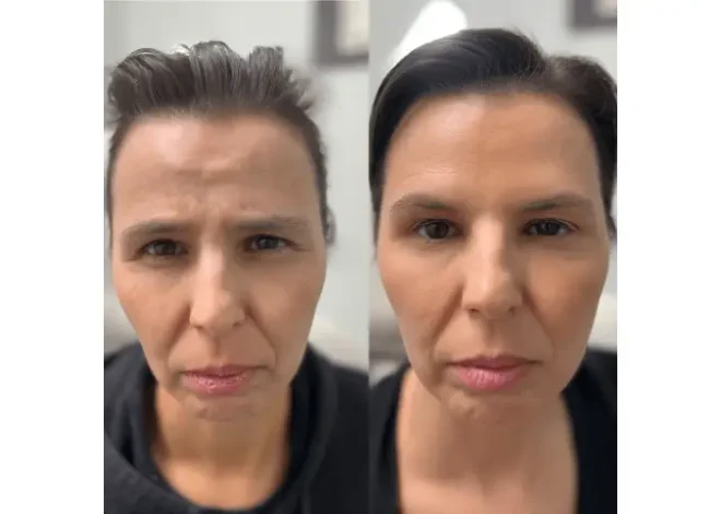 Achieve The Perfect Look With Botox Treatment In Sacramento