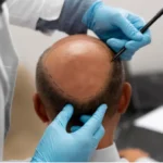 Hair Transplant in Turkey