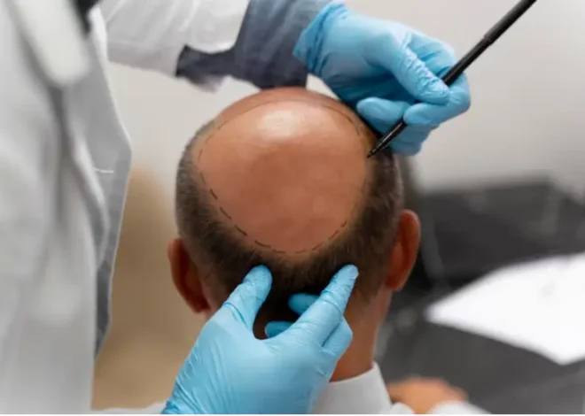 When To Book Turkey Hair Transplant With Hotel Package?