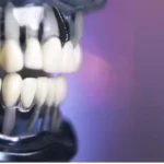 All on 4 dental implants pembroke pines