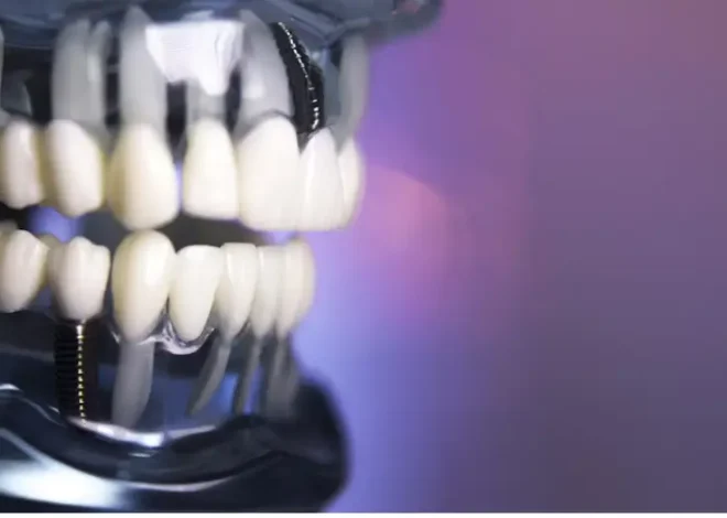 What to Expect from All-on-4 Dental Implant Surgery in Pembroke Pines?