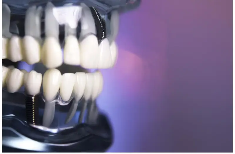 What to Expect from All-on-4 Dental Implant Surgery in Pembroke Pines?