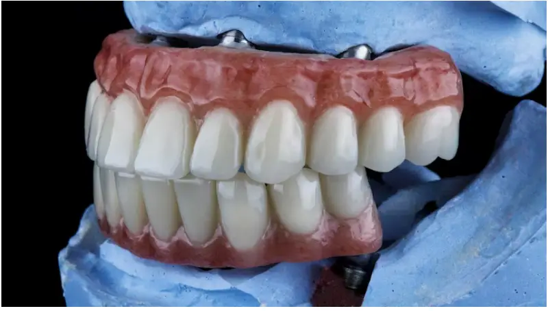 All on 4 dental implants pembroke pines