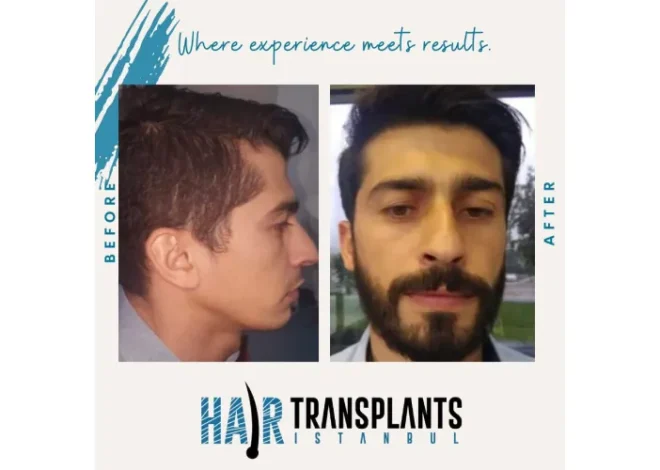 Is Hair Transplant in Turkey Safe? Facts You Should Know