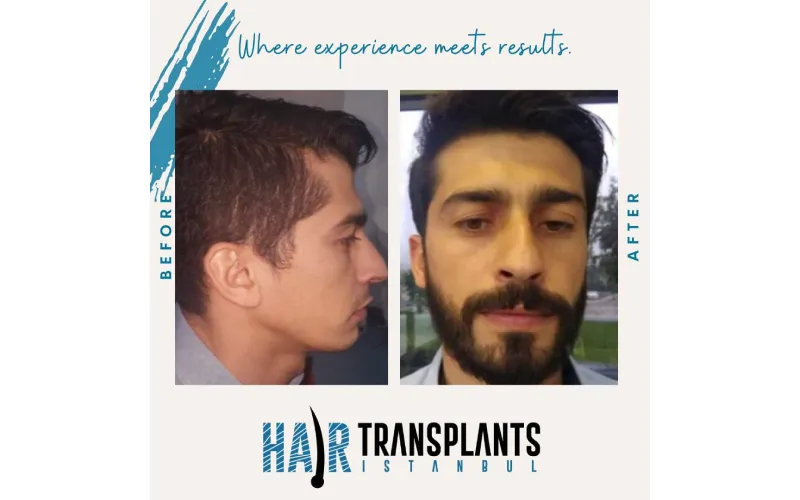 Is Hair Transplant in Turkey Safe? Facts You Should Know