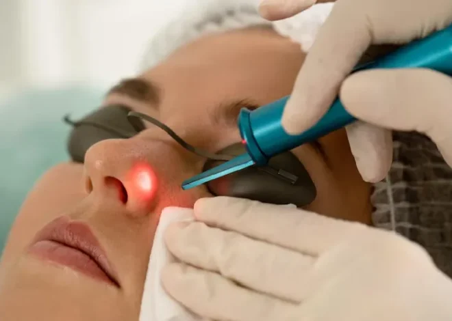 How to Care for Your Skin Post Hyperpigment Laser Treatment?
