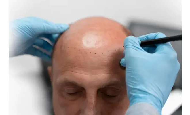 Why Hair Transplant Clinics in Turkey Are Leading the World?