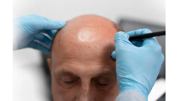 Why Hair Transplant Clinics in Turkey Are Leading the World?
